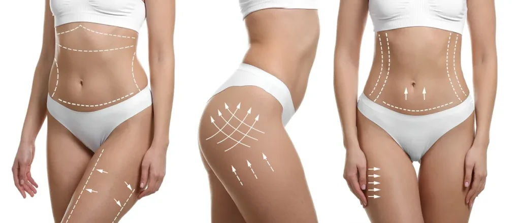 Female with Body Sculpting treatment results | Body Sculpting at Lips Boutique® and Beauty Lab in Toronto, ON