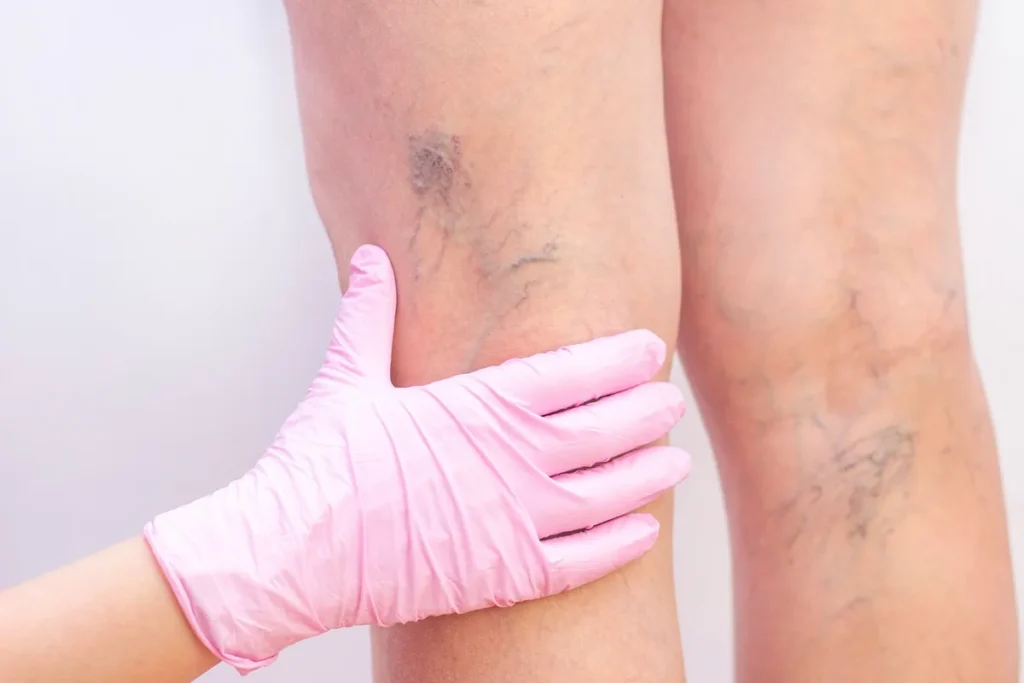 spider vein treatment by Lips Boutique by JKA Inc in Toronto, On
