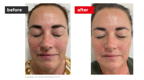 Fontona4d-6d-Before_after (1)-a--