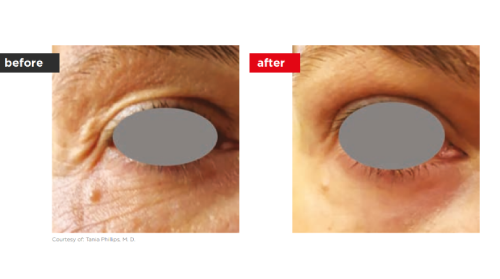 Fontona4d-6d-Before_after (2)-a--