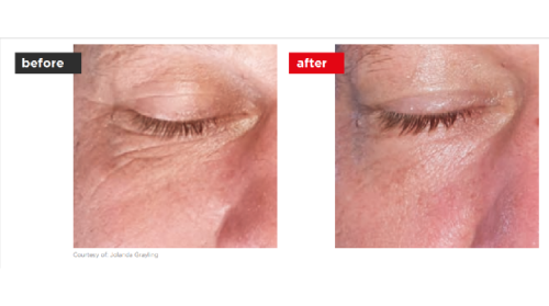 Fontona4d-6d-Before_after (3)-a--