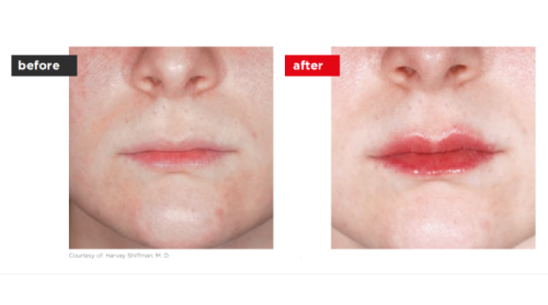 Fontona4d-6d-Before_after (5)-a--