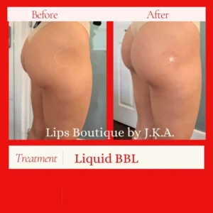Before and after Liquid BBL at Lips Boutique by JKA, Toronto,