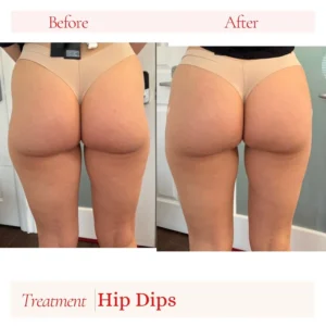 Hip Dips Treatment Before and After Gallery by Lips Boutique & Beauty Lab