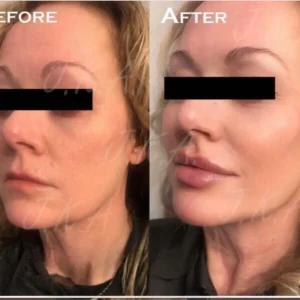 Before and after facial filler at Lips Boutique by JKA, Toronto.