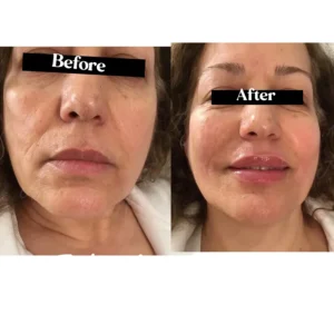 Facial filler results at Lips Boutique by JKA, Toronto – before and after.