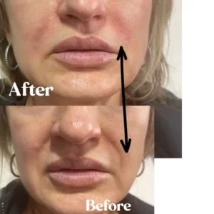 Nasolabial filler at Lips Boutique by JKA, Toronto – before and after.