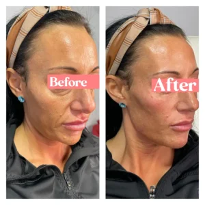 Facial filler results at Lips Boutique by JKA in Toronto, ON – before & after.