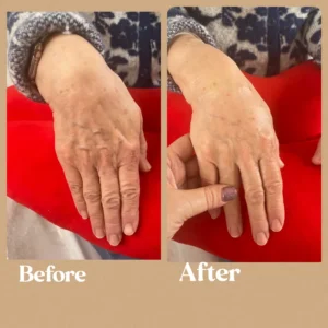 Women's Hands Rejuvenation Before and After Treatment Toronto, ON