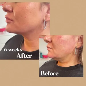 Cheeks Before and After Treatment by Lips Boutique & Beauty Lab