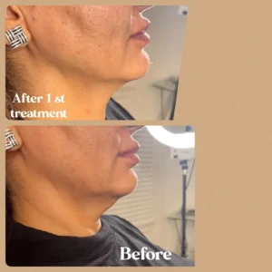 Women's Cheeks Before and After 1st Treatment by Lips Boutique & Beauty Lab