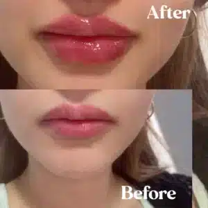 Front view of Before and after lips treatment by Lips Boutique By JKA in Toronto, ON