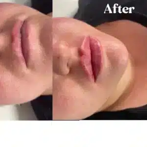 Before and after lips treatment by Lips Boutique By JKA in Toronto, ON
