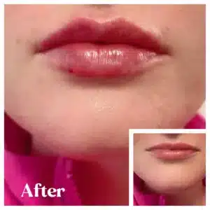 before and after lips treatment by Lips Boutique By JKA in Toronto, ON