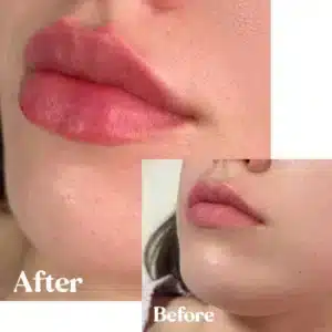 Side view of Before and after lips treatment by Lips Boutique By JKA in Toronto, ON