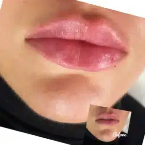 Before and after lips treatment by Lips Boutique By JKA in Toronto, ON