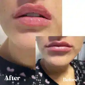 Front view of Before and after lips treatment by Lips Boutique By JKA in Toronto, ON