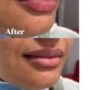 Side view of Before and after lips treatment by Lips Boutique By JKA in Toronto, ON