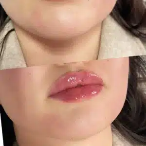 Before and after lips treatment by Lips Boutique By JKA in Toronto, ON