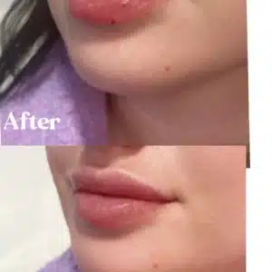 Women showing before and after lips treatment by Lips Boutique By JKA in Toronto, ON