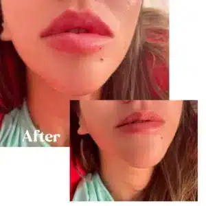Before and after lips treatment by Lips Boutique By JKA in Toronto, ON