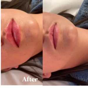 Before and after lips treatment by Lips Boutique By JKA in Toronto, ON