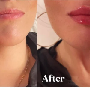 Before and after lips treatment by Lips Boutique By JKA in Toronto, ON
