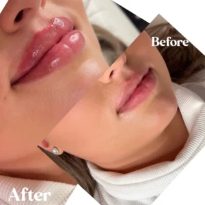 Women showing before and after lips treatment by Lips Boutique By JKA in Toronto, ON