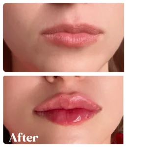 Women showing before and after lips treatment by Lips Boutique By JKA in Toronto, ON