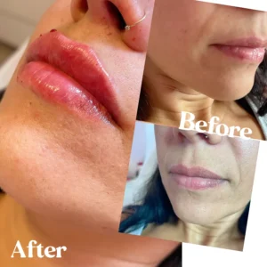Lip Fillers In Toronto, ON | Lips Boutique by JKA