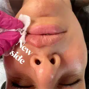 Best Lip Filler Services | Lips Boutique by JKA In Toronto, ON