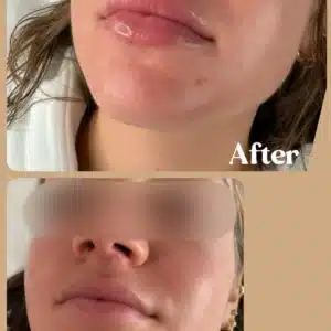 Best Lip Filler Services | Lips Boutique by JKA In Toronto, ON
