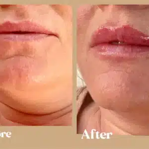 Lip Filler Injections In Toronto, ON | Lips Boutique by JKA