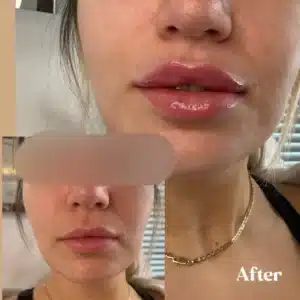Before and After Lip fillers | Lips Boutique by JKA In Toronto, ON