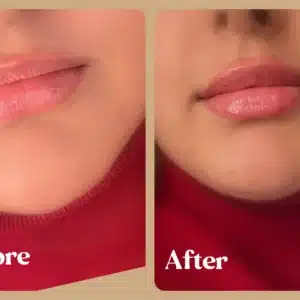 Best Lip Filler treatments | Lips Boutique by JKA In Toronto, ON
