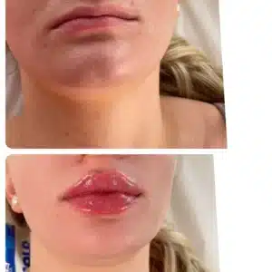 Lip Filler Services | Lips Boutique by JKA In Toronto, ON