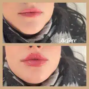 Before and After Gallery | Lips Boutique by JKA In Toronto, ON