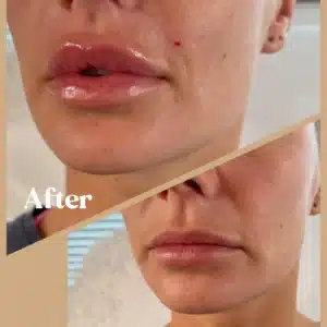 Before And Lip Filler Treatments | Lips Boutique by JKA In Toronto, ON