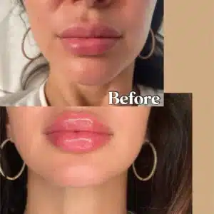 Before and After Gallery | Lips Boutique by JKA, Toronto, ON