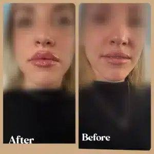 Lip Fillers Before and After Gallery in Toronto, ON