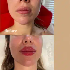 Before and After Gallery | Lips Boutique by JKA, Toronto, ON