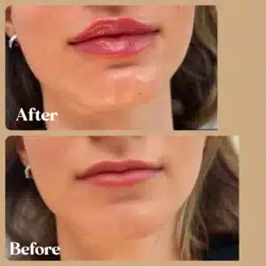 Before and After Gallery | Lips Boutique by JKA, Toronto, ON