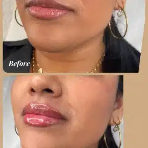 Before and after lip Filler results at Lips Boutique by JKA, Toronto, ON