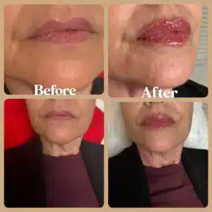 Before and After Treatments Images | Lips Boutique by JKA, Toronto, ON