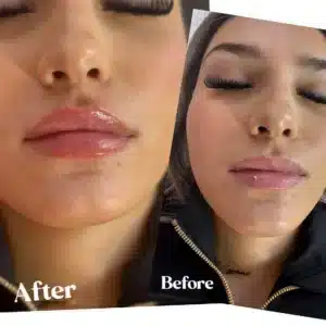Before and after lip enhancement results at Lips Boutique by JKA, Toronto, ON