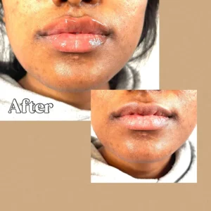 Before and after lip enhancement treatment at Lips Boutique by JKA in Toronto, ON