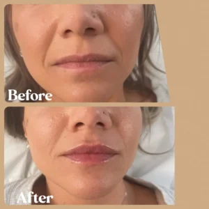 Women showing before and after lips treatment in Toronto, ON