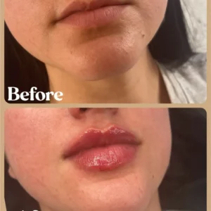Women showing before and after lips treatment in Toronto, ON