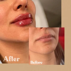 Women showing before and after lips treatment in Toronto, ON