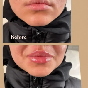 Women showing before and after lips treatment in Toronto, ON